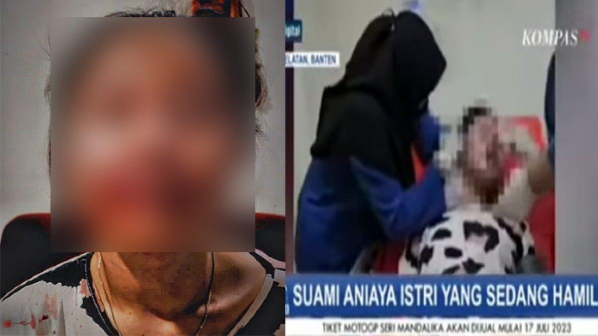 Kondisi Tiara setelah dianiaya suaminya