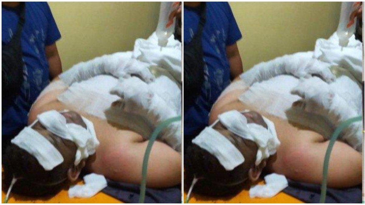 Kondisi Yusuf sekujur tubuhnya diperban usai kena ledakan septic tank.