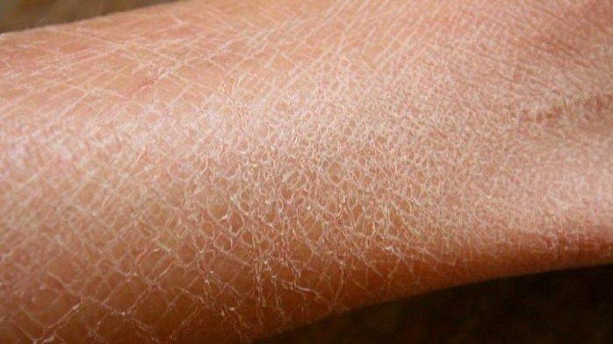 kulit kering yang biasa terjadi ketika musim panas