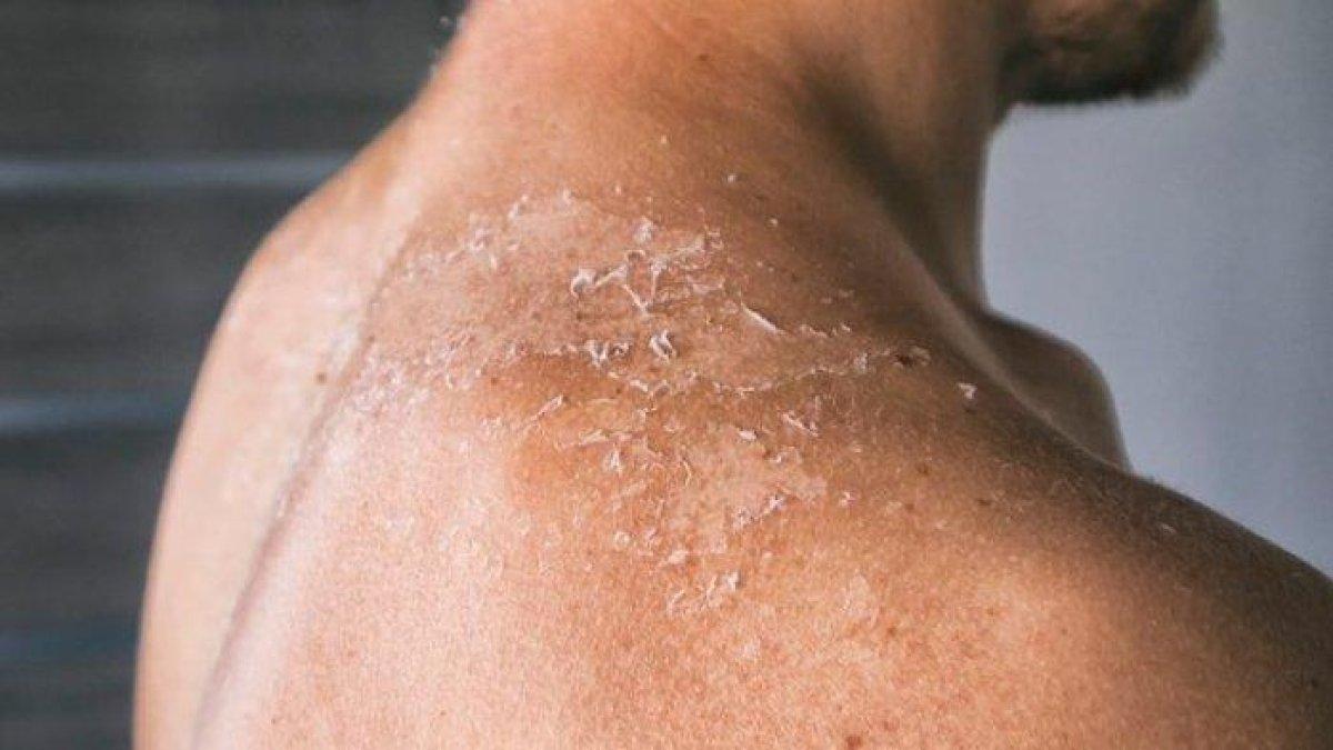 5 cara mengobati penyakit kulit secara alami