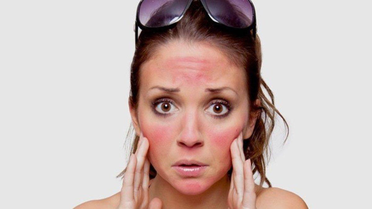 6 bahan alami untuk mengobati kulit yang terbakar matahari