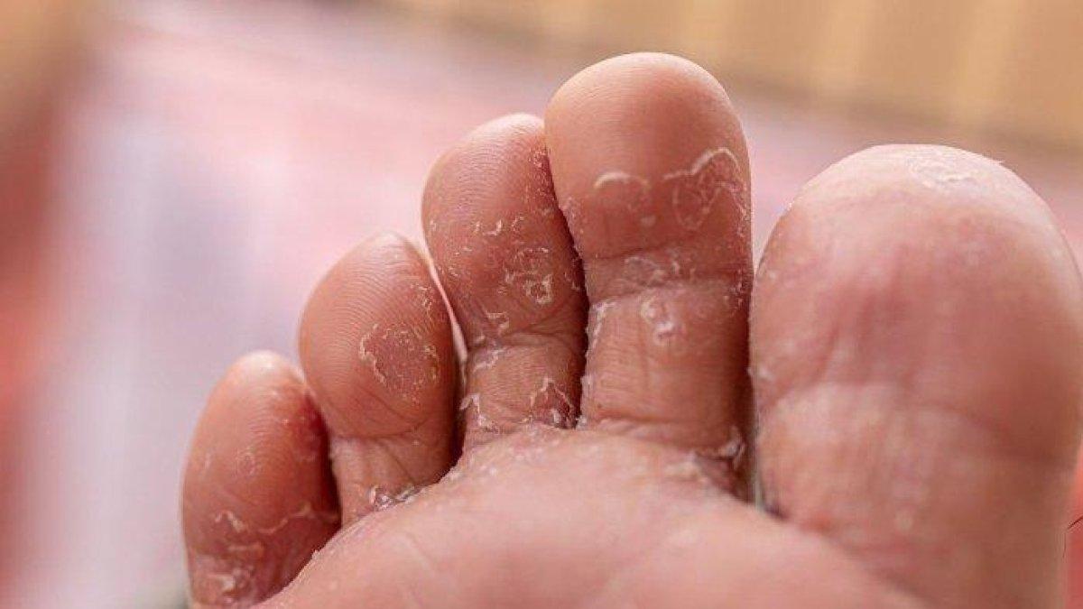 3 bahan untuk mengobati kutu air secara alami