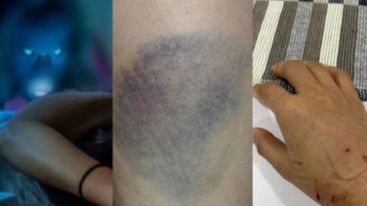 Luka lebam dan bekas cakaran