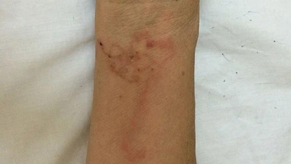 Awalnya wanita tersebut sempat merasakan hasil dari diet yang tidak biasa ini, hingga akhirnya mengalami berbagai gejala yang mencemaskan.
