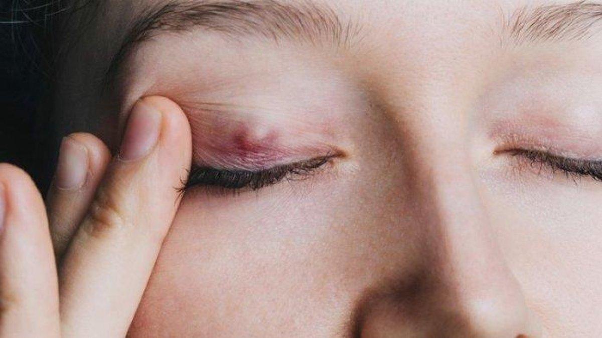 7 cara megobati mata bintitan secara alami