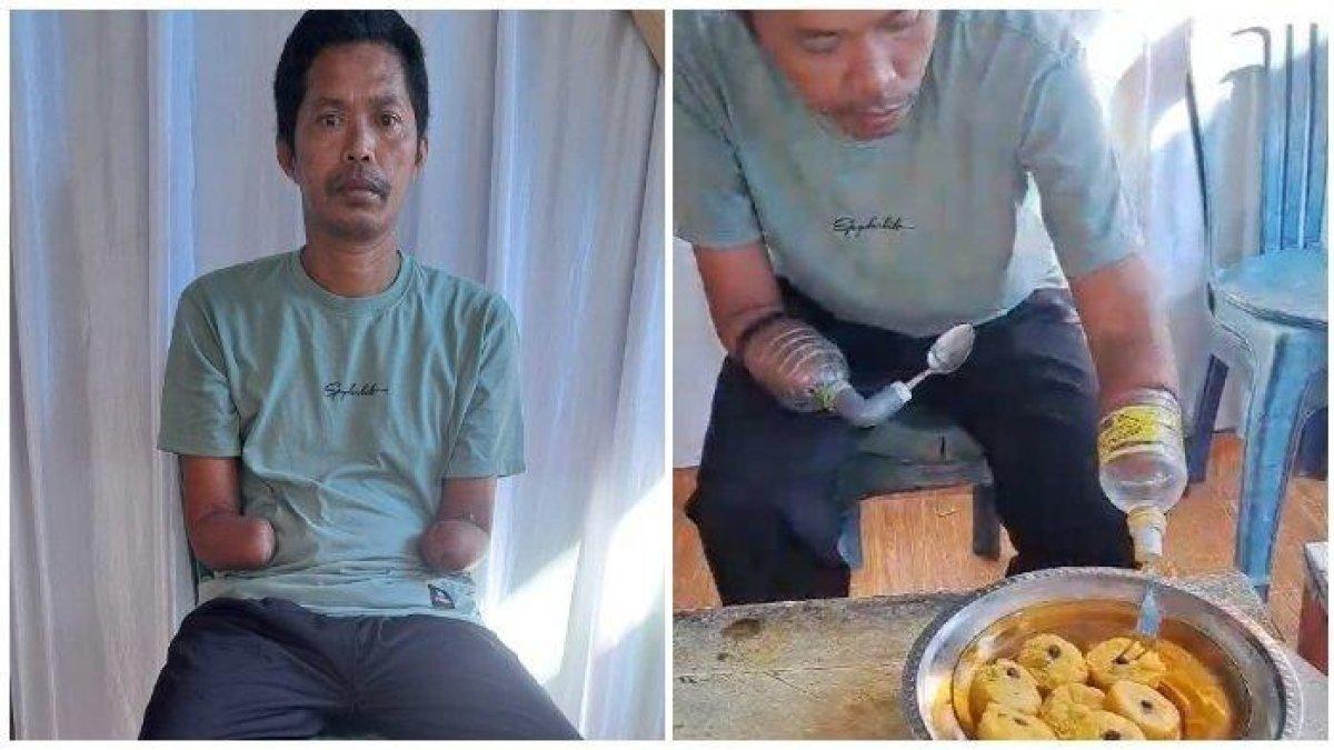 Kisah seorang pria bernama Indrawansyah (40) menjadi sorotan karena harus menggunakan bekas botol air mineral untuk menyambung tangannya.