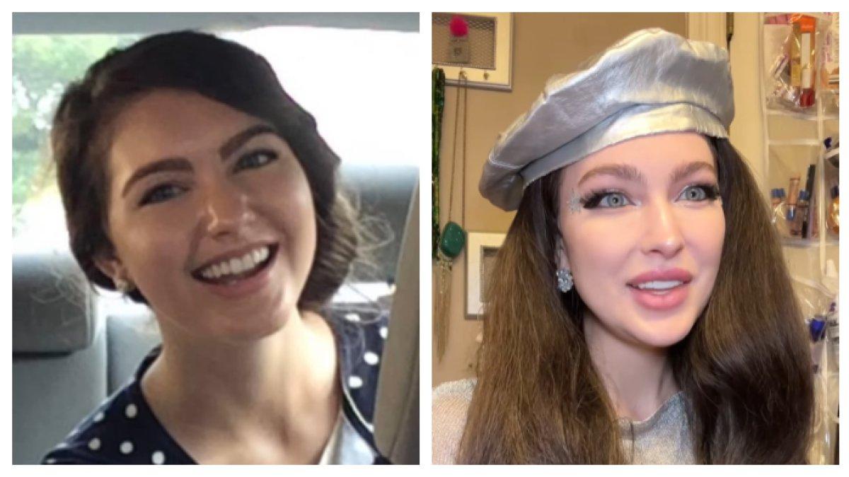 PASANGAN LAKUKAN OPLAS - Pasangan sama-sama memiliki hobi Oplas hingga habiskan Rp 570 Juta. Kini masih terus lakukan oplas demi hasil yang memuaskan.