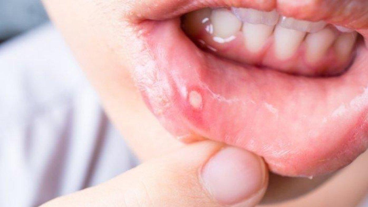 6 cara mengatasi sariawan secara alami