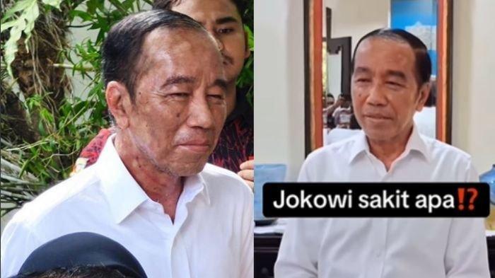 PENYAKIT JOKOWI - Kolase foto wajah Jokowi sekarang yang disebut memiliki penyakit langka, bukan Sindrom Stevens-Johnson, melainkan Autoimun Agresif, Senin (23/6/2025). Bukan alergi kulit. Rocky Gerung sebut sakit Jokowi disebabkan karena psikosomatik, gangguan kejiwaan (psikosomatik) yang tidak bisa diatasi tubuh.