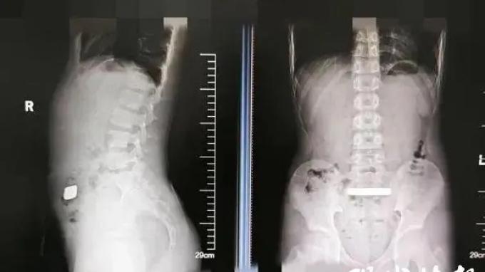 VIRAL DI CHINA - Tangkap layar pemberitaan dari Modern Express News (现代快报 - Xiandai Kuaibao) 8 April 2025, memperlihatkan hasil rontgen anak laki-laki yang menelan emas batangan. Anak 11 tahun itu awalnya mengeluh perutnya terasa kembung dan membengkak