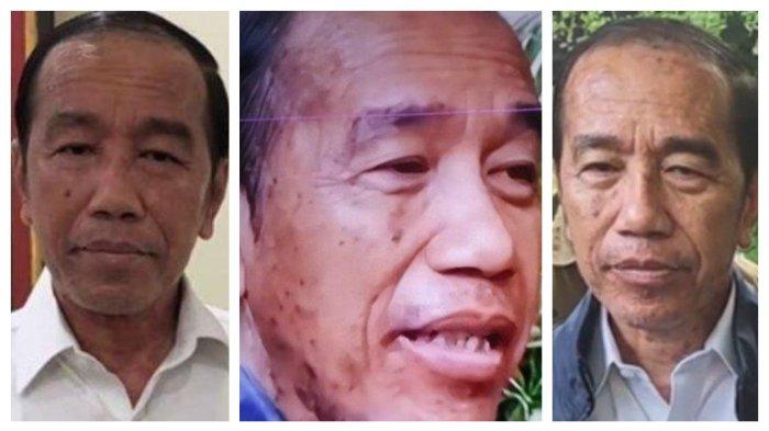 WAJAH JOKOWI TERKINI - Kolase foto wajah Jokowi yang tampak berubah usai disebut mengalami sakit autoimun, Jumat (13/6/2025). Dulu banyak bercak hitam, kini banyak bercak putih, warga kulit berubah drastis. Jokowi tegaskan hanya alergi kulit biasa sepulang dari Vatikan.