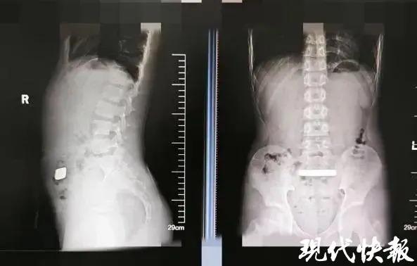 VIRAL DI CHINA - Tangkap layar pemberitaan dari Modern Express News (现代快报 - Xiandai Kuaibao) 8 April 2025, memperlihatkan hasil rontgen anak laki-laki yang menelan emas batangan. Anak 11 tahun itu awalnya mengeluh perutnya terasa kembung dan membengkak