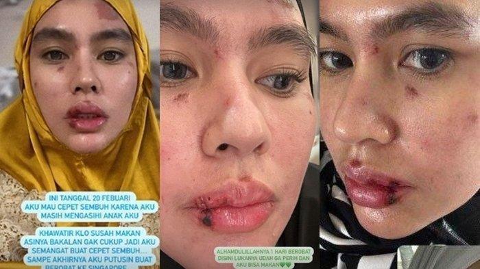 Awal Mula Wajah dan Lidah Kartika Putri Melepuh, Ternyata Punya Autoimun: Awalnya Kayak Ada Airnya
