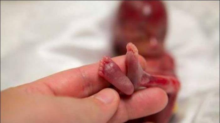 Foto Ilustrasi. Kronologi Kepala Bayi Putus dan Ketinggalan di Rahim Ibu, Minta Dirujuk Tapi Tak Ditangani Puskesmas