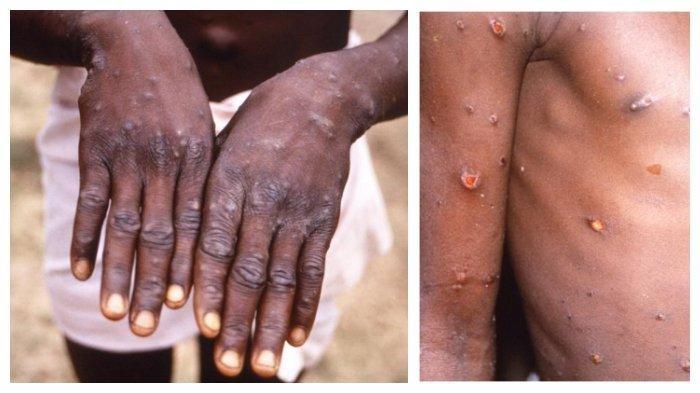 Mengenal MPOX, Penyakit Cacar Monyet yang Saat Ini Kembali Viral, Ada 88 Kasus di Indonesia