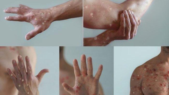 Mpox - Monkeypox. Mengenal MPOX, Penyakit Cacar Monyet yang Saat Ini Kembali Viral, Ada 88 Kasus di Indonesia