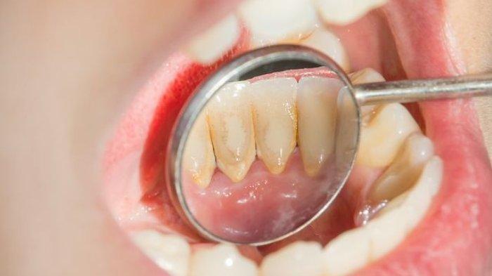 Scaling Gigi Ditanggung BPJS Kesehatan, Ini Syarat yang Diperlukan