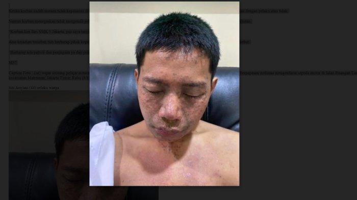 Seorang pelajar disiram air keras di wajah