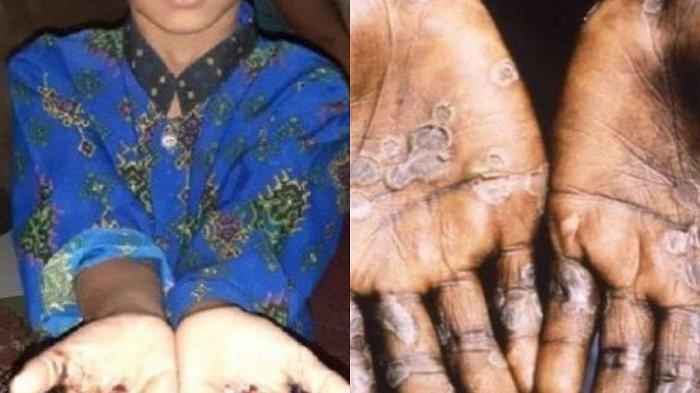 Bandingkan foto orang terkena cacar monyet bersumber dari WHO dan anak warga Cianjur, Jawa Barat, yang tangannya diduga terkena cacar monye.