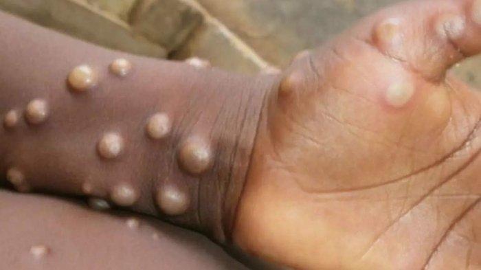 Sebagian besar kasus cacar monyet atau Monkeypox baru-baru ini telah diidentifikasi diantara pria gay, biseksual, dan pria lain yang berhubungan seks dengan sesama pria.