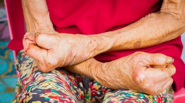 ES, warga Tangsel, sangat menyedihkan, menderita kusta, namun diabaikan pemerintah.