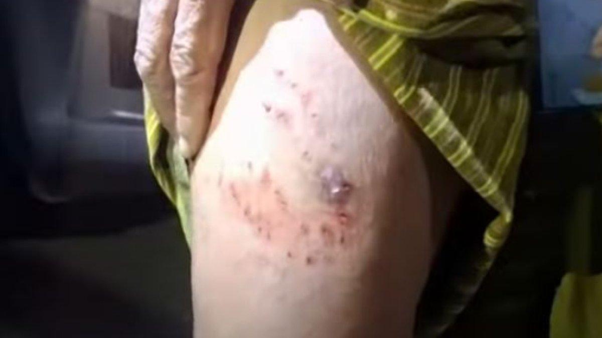 Luka akibat gigitan ular piton di kaki Arom. (19/9/2024)
