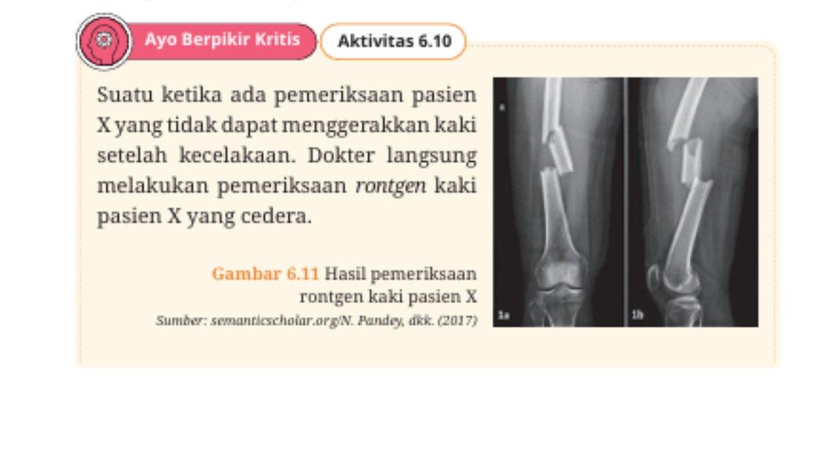 Gambar 6.11 Halaman 189 buku Biologi kelas 11 SMA kurikulum merdeka tentang hasil pemeriksaan rontgen kaki pasien X.