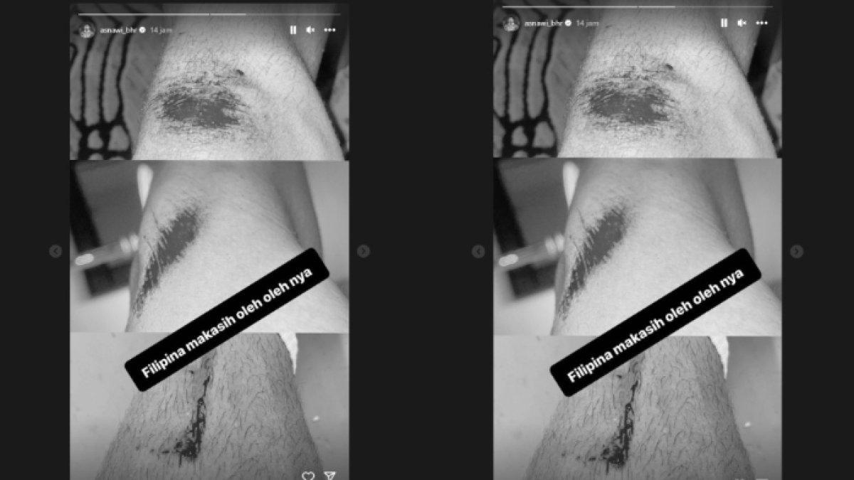Luka di kaki Asnawi setelah jatuh di rumput sintetis laga lawan Filipina